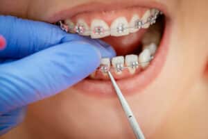 Affordable Braces in Richmond