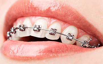 Adult Braces Implant Glen Allen VA