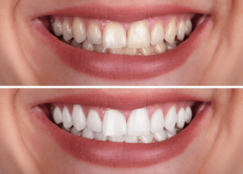 before and after zoom whitening at villa orthodontics