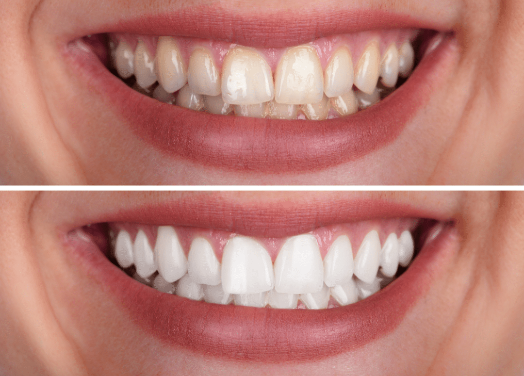 Teeth Whitening